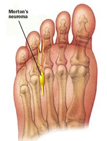 Mortonse neuralgie