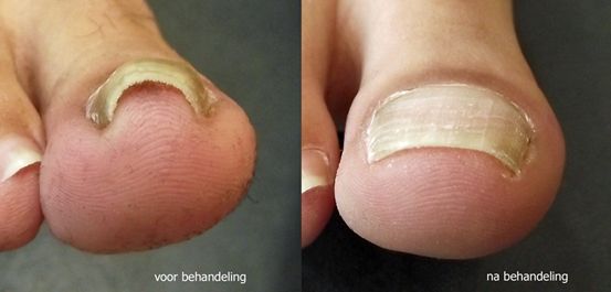 Nagelbeugel voor en na